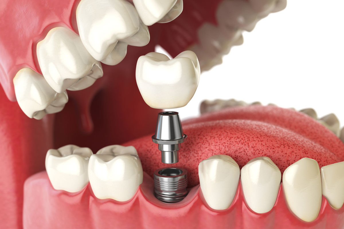 Implants